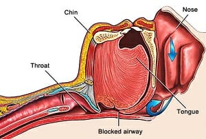 Drawing of an airway that's blocked by the back of the tongue, causing Obstructive Sleep Apnea 