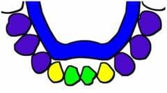 Illustration of how pressure is shifted from the front teeth to the sides 