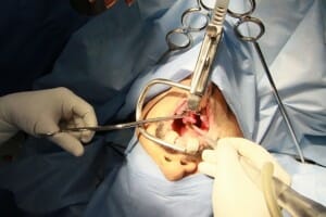 snoring surgery