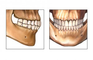 occlusion