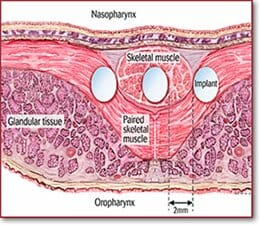 Pillar procedure insertion