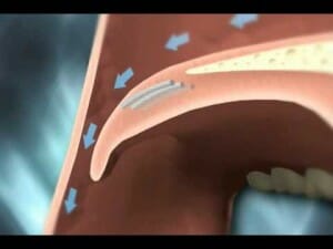 soft palate vibration