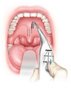 pillar insertion