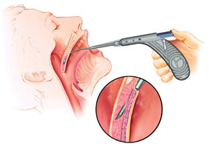 Device is used to cut into soft palate and insert pillars