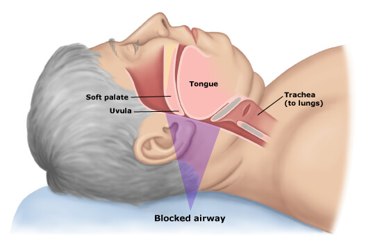 blocked airway