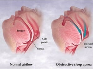 obstructive sleep apnea