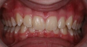 Example of an excessive overbite