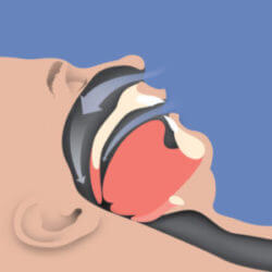 Illustration of man experiencing obstructive sleep apnea 