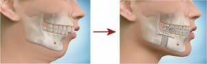 mandibular advancement surgery