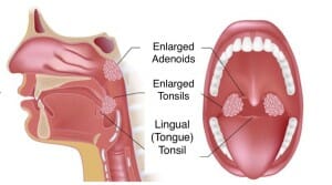 adenoid diagram