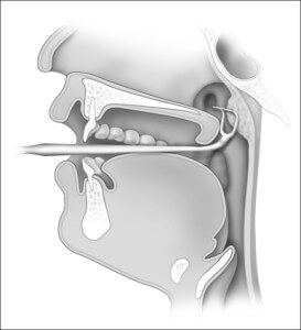 adenoidectomy diagram