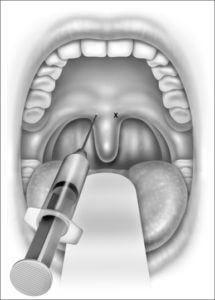 injection snoreplasty