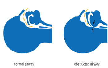 Comparison of clear airway and obstructed airway