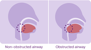 osa4