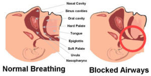 snoring-breathing