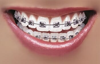 braces