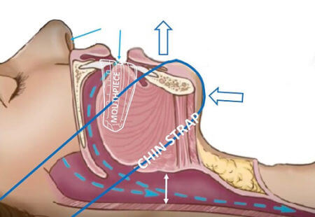 How Snoretek chinstrap holds jaw forward