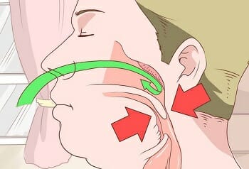 Illustration showing blocked airway