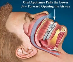 Illustration of how oral appliance pulls jaw forward to open airway