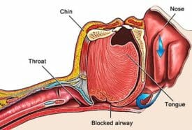 Drawing of an airway that is obstructed by the tongue muscle