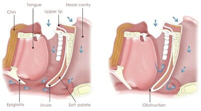 Will Sleeping On Your Side Stop Snoring? How Positional Therapy Can ...